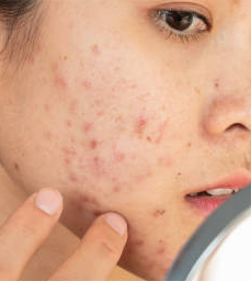 Acne or Ezcema Sensitive Skin